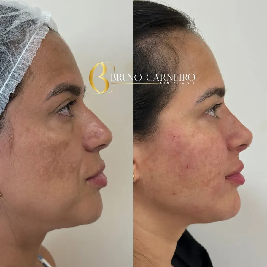 Perfil de paciente antes e depois da harmonização full face